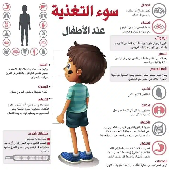 سوء التغذية عند الاطفال المرضى بالعيوب الخلقية للقلب