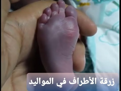 اسباب ازرقاق الطفل و الرضيع 5 اسباب ازرقاق الطفل و الرضيع