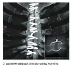 التئام العظام بعد عملية القلب المفتوح؟