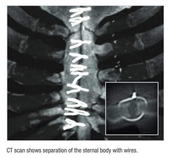 التئام العظام بعد عملية القلب المفتوح؟ 6 التئام العظام بعد عملية القلب المفتوح؟