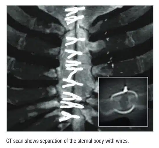 التئام العظام بعد عملية القلب المفتوح؟
