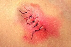 التهاب الجرح بعد عملية القلب المفتوح