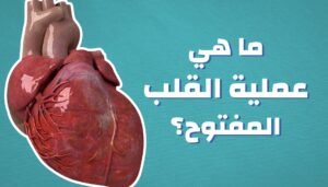 خطوات عملية القلب المفتوح