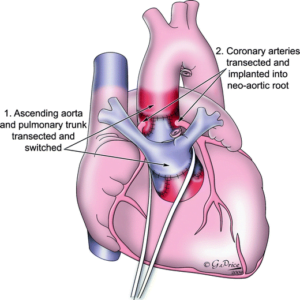 عملية تبديل شرايين القلب للاطفال ، المعروف أيضًا باسم عملية انعكاس شرايين القلب ، هي جراحة قلب مفتوحة لتصحيح تبدل الشرايين الكبرى (D-TGA) على مستوى الشريان الأورطي والشريان الرئوي الرئيسي. فتابع بالقراءة لتعرف اکثر.