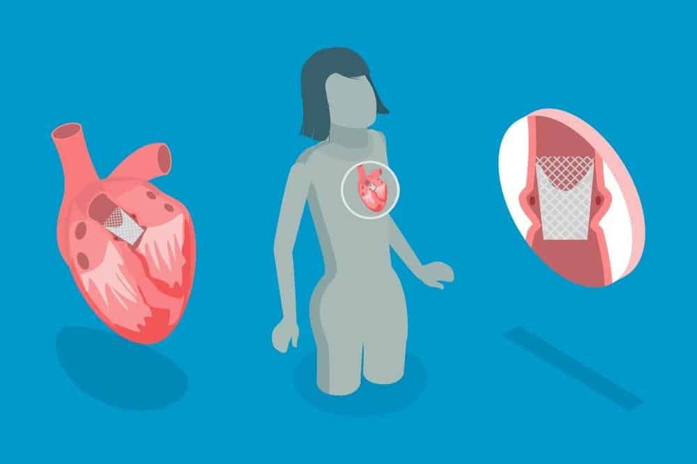 علاج صمامات القلب دون جراحة