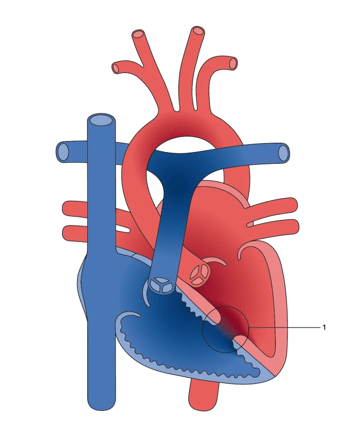 فتحة في القلب عند الاطفال
